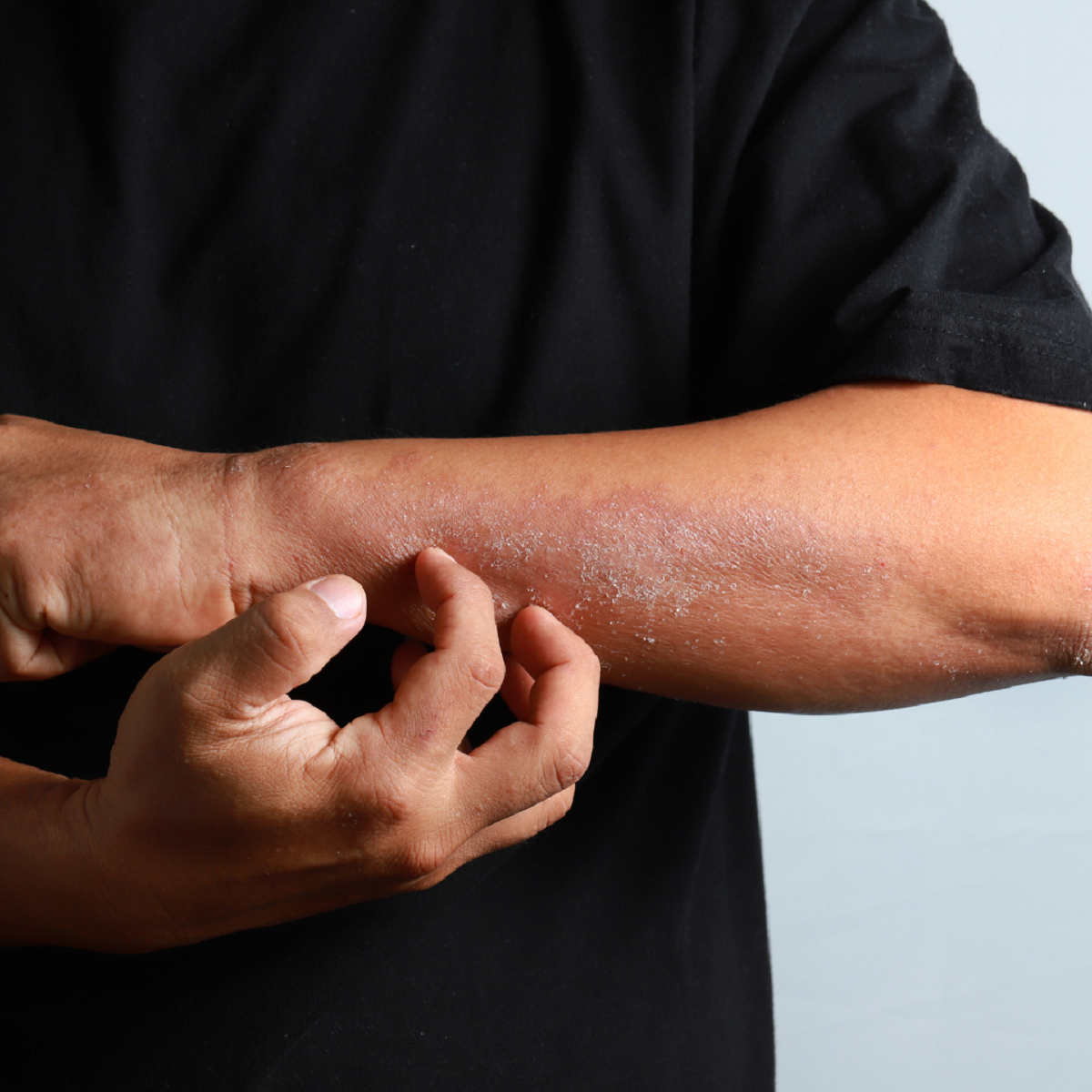 Psoriasis